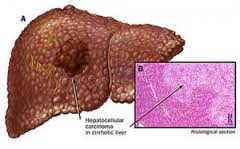 epatite c fegato